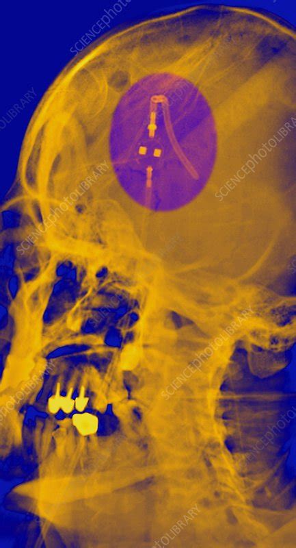 Ventricular shunt, X-ray - Stock Image - C016/6695 - Science Photo Library