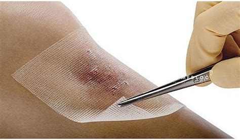 Antimicrobial Dressing – MedLoc