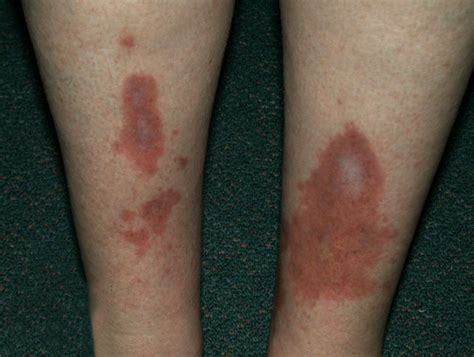 How Does Diabetic Skin Rash Look Like?