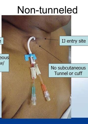 Groshong Catheter Vs Picc Line