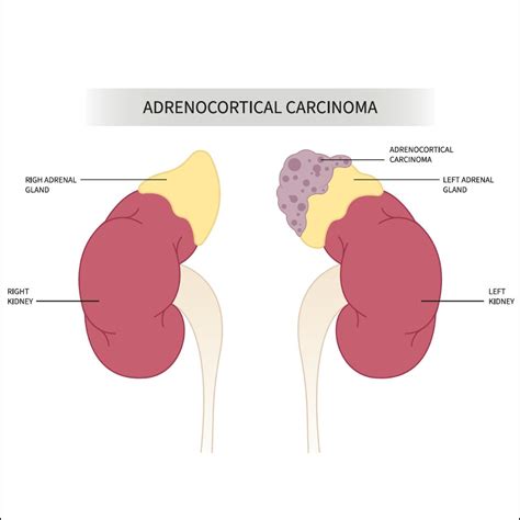 Adrenocortical Carcinoma: Causes, Risk Factors, Symptoms, Treatment