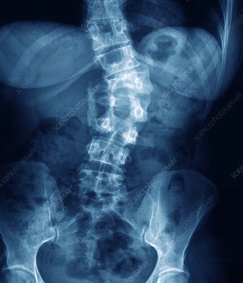 Broken back, X-ray - Stock Image - M330/1307 - Science Photo Library