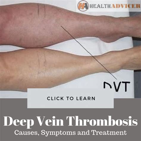 Deep Vein Thrombosis Causes Picture Symptoms And Treatment – Themelower