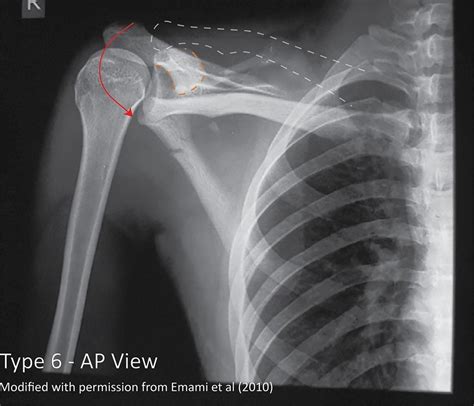 Rockwood classification of acromioclavicular joint injury: annotated ...