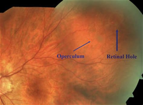 Lesson: Know Your Retinal Breaks, Tears and Holes