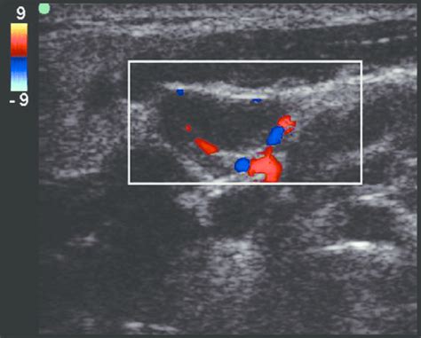 Swollen Lymph Nodes In Neck Ultrasound