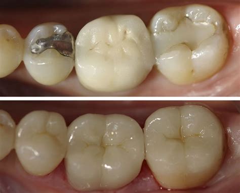 Before and After: Patient had two molars with old, broken, composite fillings in need of repair ...