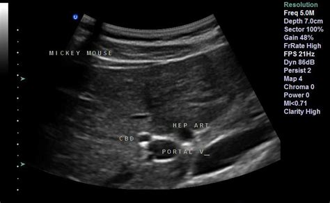 portal triad | Ultrasound, Sonography, How to memorize things