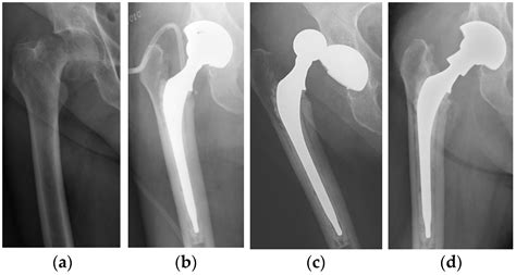 Total hip vs hemiarthroplasty femoral neck fracture - sakinaughty