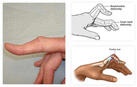 Boutonniere Deformity - Richard Stephen Gilbert, M.D.