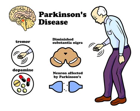 parkinson's disease may be stopped