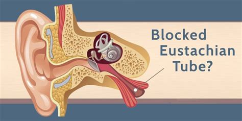 What a blocked Eustachian Tube means - Wax Removal NI