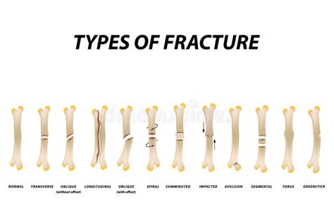 6 Types Of Fractures