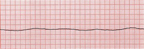 B20: Cardiac Asystole: ECGs at St Emlyn's