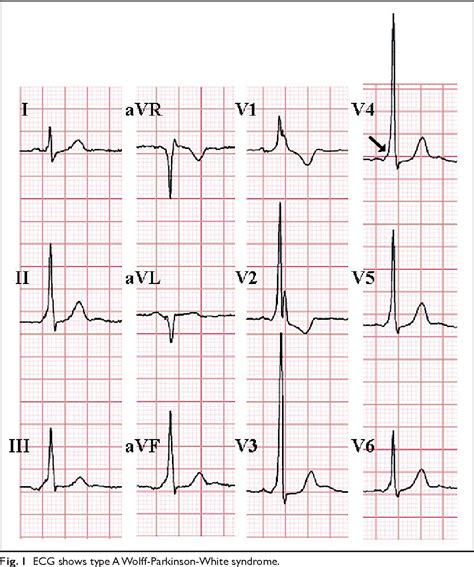 Figure 3 from ECG delta waves in patients with palpitation. | Semantic Scholar