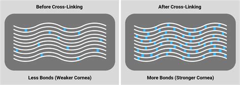 Corneal Collagen Cross-Linking