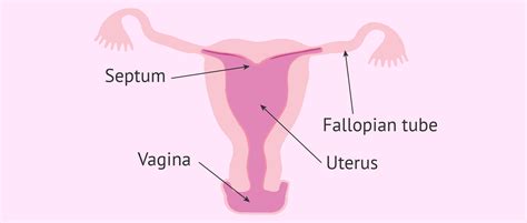 Arcuate uterus diagram