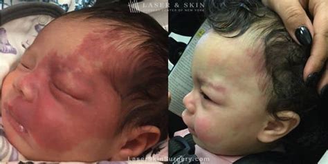 Treat Port-Wine Birthmarks Early to Avoid Progression - Laser NY