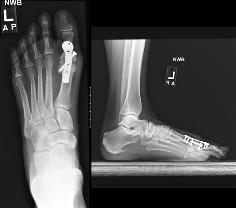 What Is A 1st Metatarsophalangeal Joint Mtpj Fusion - vrogue.co