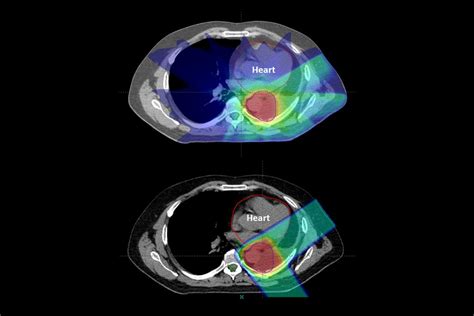 Proton therapy for cancer lowers risk of side effects