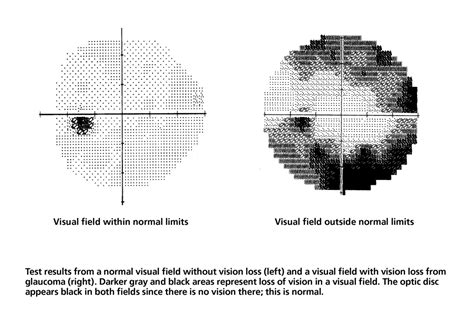 What Is A Visual Field Test? - Glaucoma Research Foundation