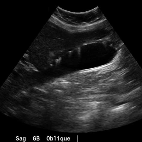 Adenomyomatosis of the gallbladder | Radiology Reference Article ...