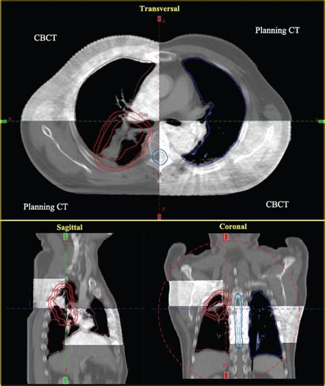 Cone Beam Ct In Radiotherapy - The Best Picture Of Beam