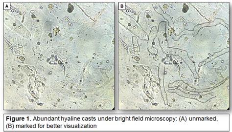 Urine Sediment of the Month: Colorless, Transparent Hyaline Casts ...