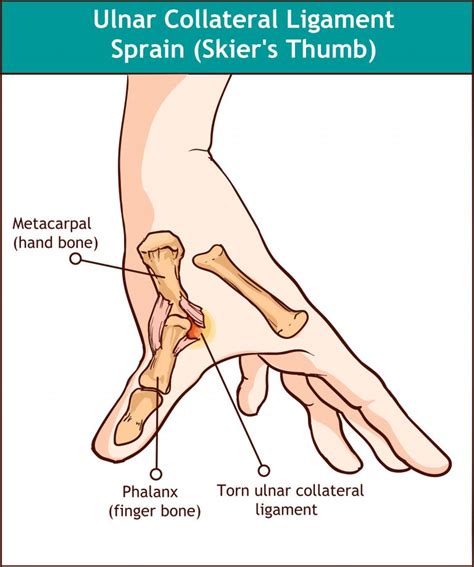 Common Thumb Injuries - My Family Physio