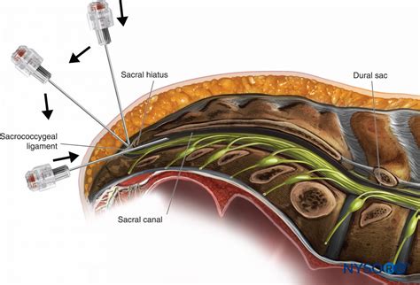 Spinal Abscess: Complications of Epidural Anesthesia