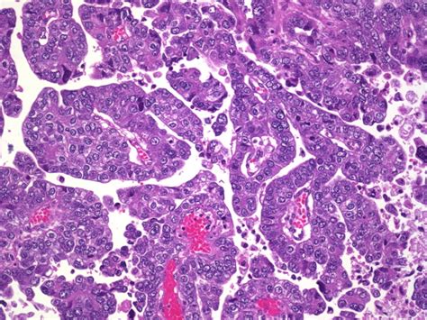 Webpathology.com: A Collection of Surgical Pathology Images