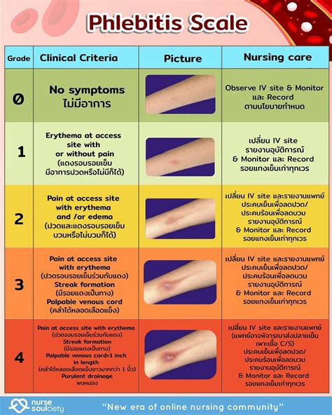 Visual Infusion Phlebitis Score Chart