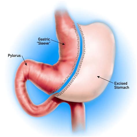 How to Minimize Gastric Sleeve Complications - Weight Loss Surgery