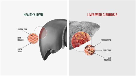 Causes, symptoms and prevention methods for hepatic steatosis - ProHumano+ Health Support