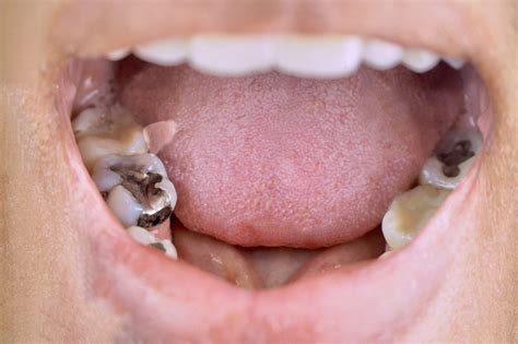 Tooth Fillings: What are the Different Types?