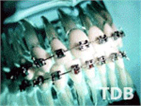 Braces - Orthodontics. Dental Braces Bangkok, Orthodontics Thailand.