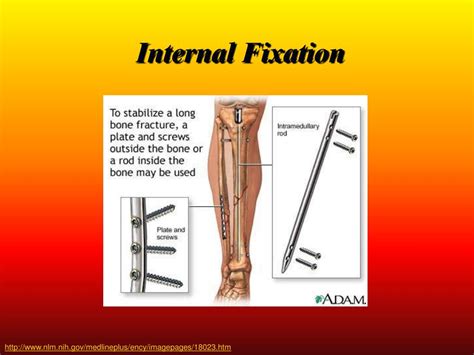 PPT - Fracture Fixation Internal & External PowerPoint Presentation ...