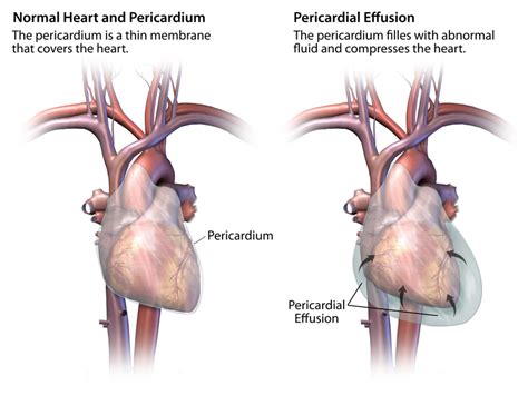 Pericarditis and pericardial effusion | Cardiac Health