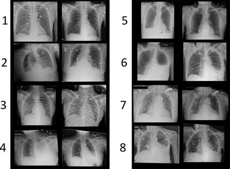 Percutaneous thoracostomy with thoracic lavage for traumatic hemothorax: a performance ...