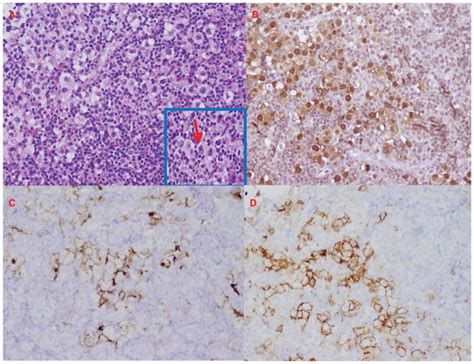 Pituitary stalk lesion in a 13-year-old female. - Abstract - Europe PMC