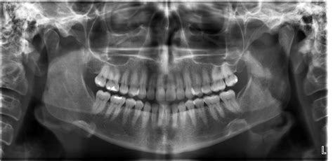 Pan/Bitewing Patient Studies