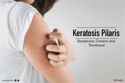 Keratosis Pilaris - Symptoms, Causes and Treatment - By Dr. Nivedita Dadu | Lybrate