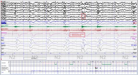 Catathrenia and Treatment With Positive Airway Pressure in the ...