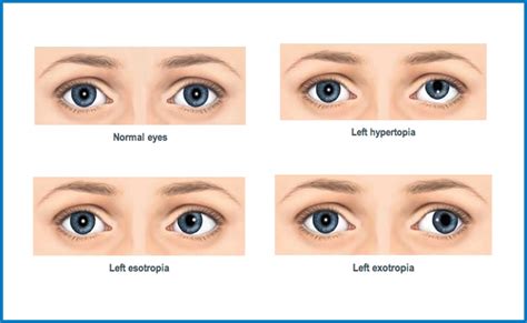 Children and Strabismus: Detecting and Managing Childhood Squint