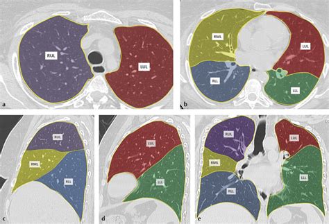 4 Lungs | Radiology Key