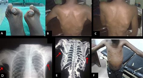 Fibrodysplasia Ossificans Progressiva: A Report of Four Cases | Cureus