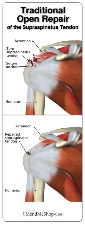 Rotator Cup Healing Stretching & Exercise