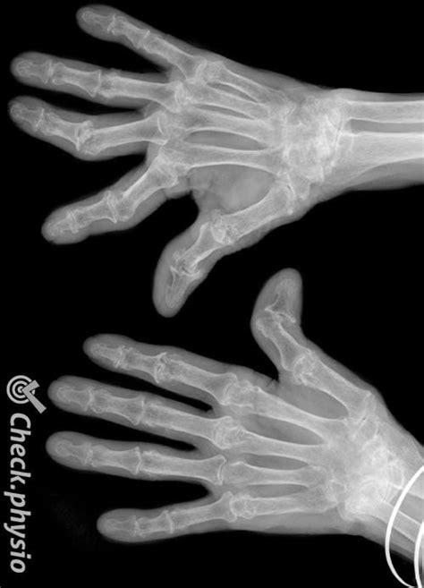 Rheumatoid arthritis | Physio Check