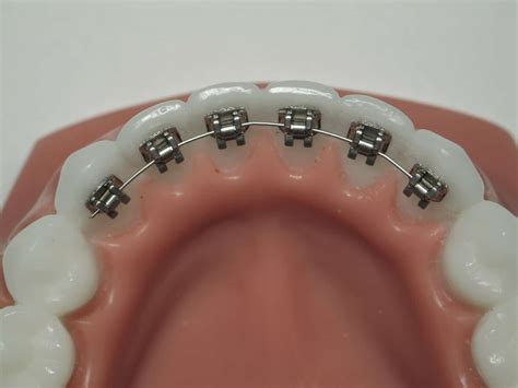 Lingual Braces