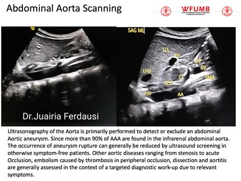 Ultrasound the Best #14: Abdominal Aorta Scanning – WFUMB